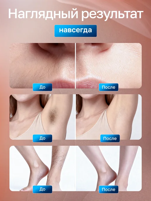 TexnoParts Фотоэпилятор лазерный профессиональный, вариант, фото 3