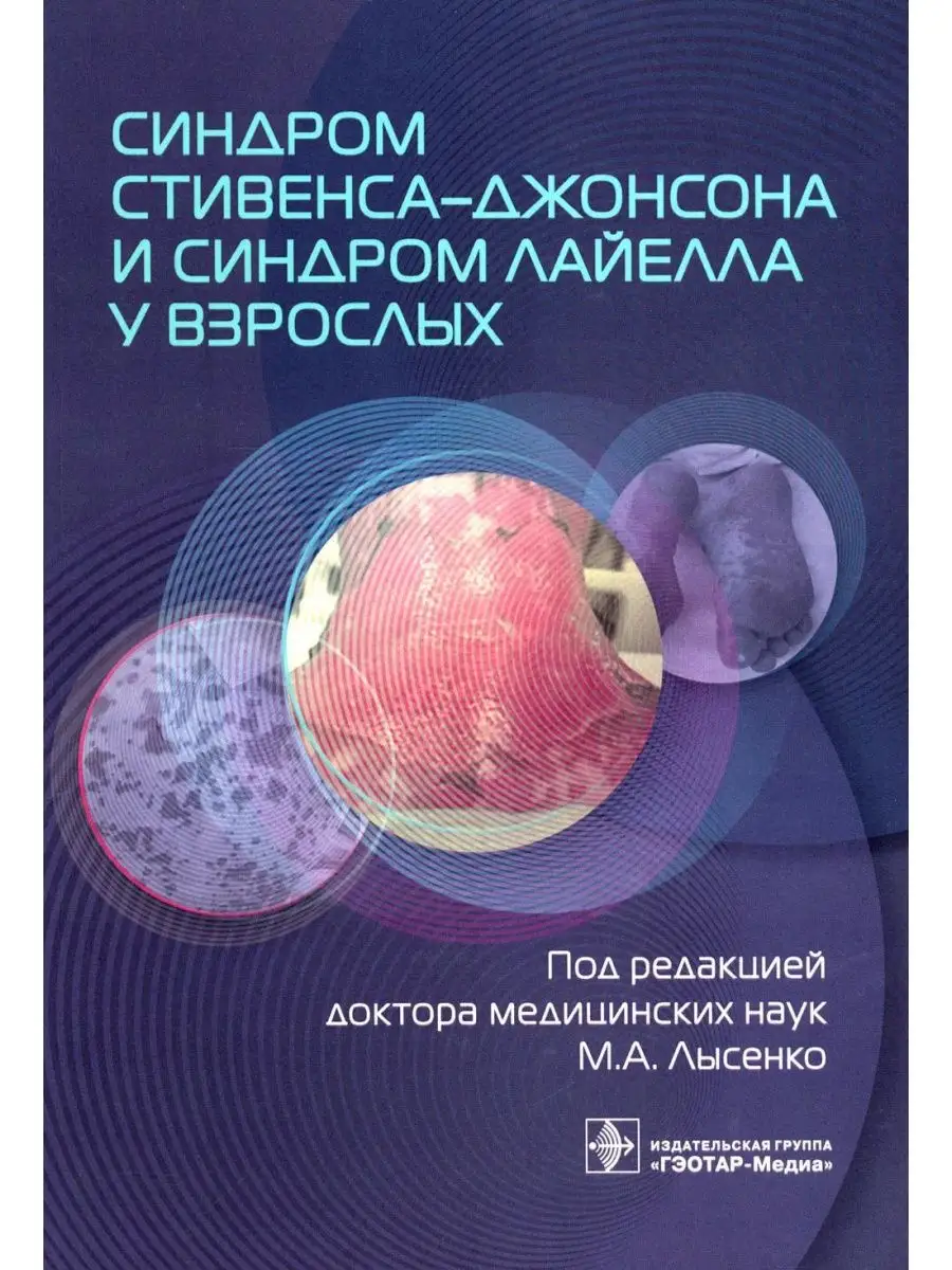 Синдром Стивенса-Джонсона и синдром Лайелла у взрослых ГЭОТАР-Медиа  145169297 купить за 728 ₽ в интернет-магазине Wildberries