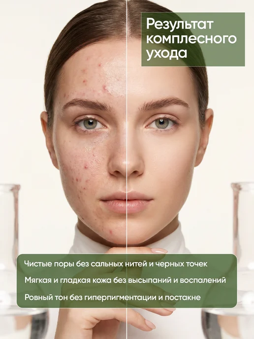 ARAVIA Laboratories Набор уходовой косметики от прыщей азелаиновая кислота, зеленый, фото 2