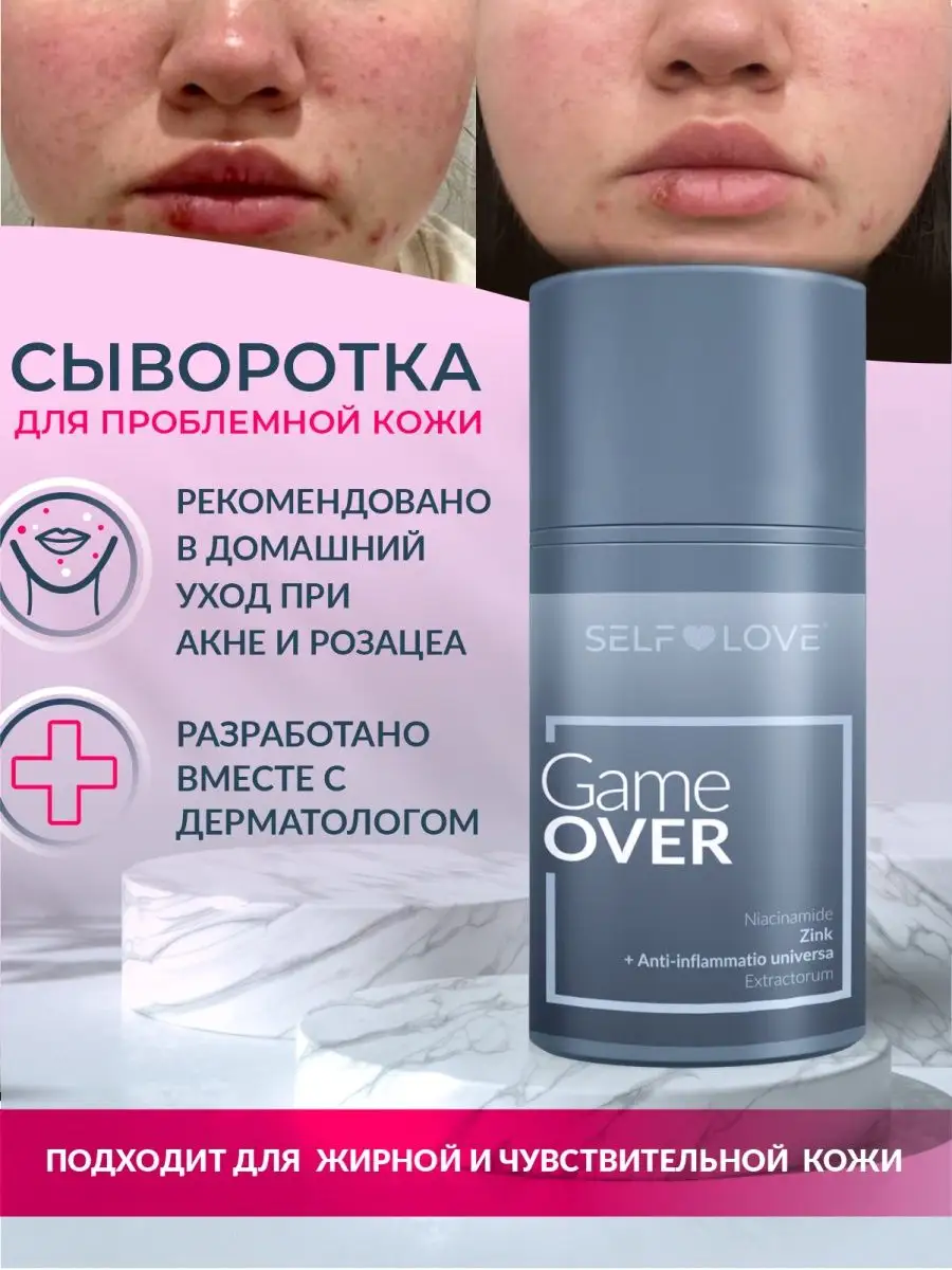 Сыворотка себорегулирующая для лица от прыщей акне постакне SelfLove  cosmetics 154693451 купить в интернет-магазине Wildberries