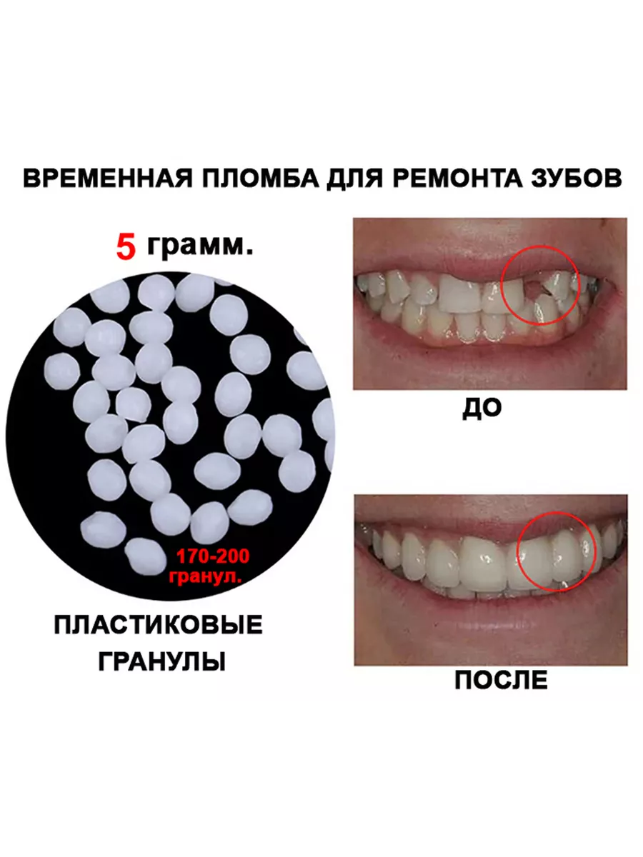 Временная пломба зуб 5 грамм. Полезные мелочи! 159811030 купить за 135 ₽ в  интернет-магазине Wildberries